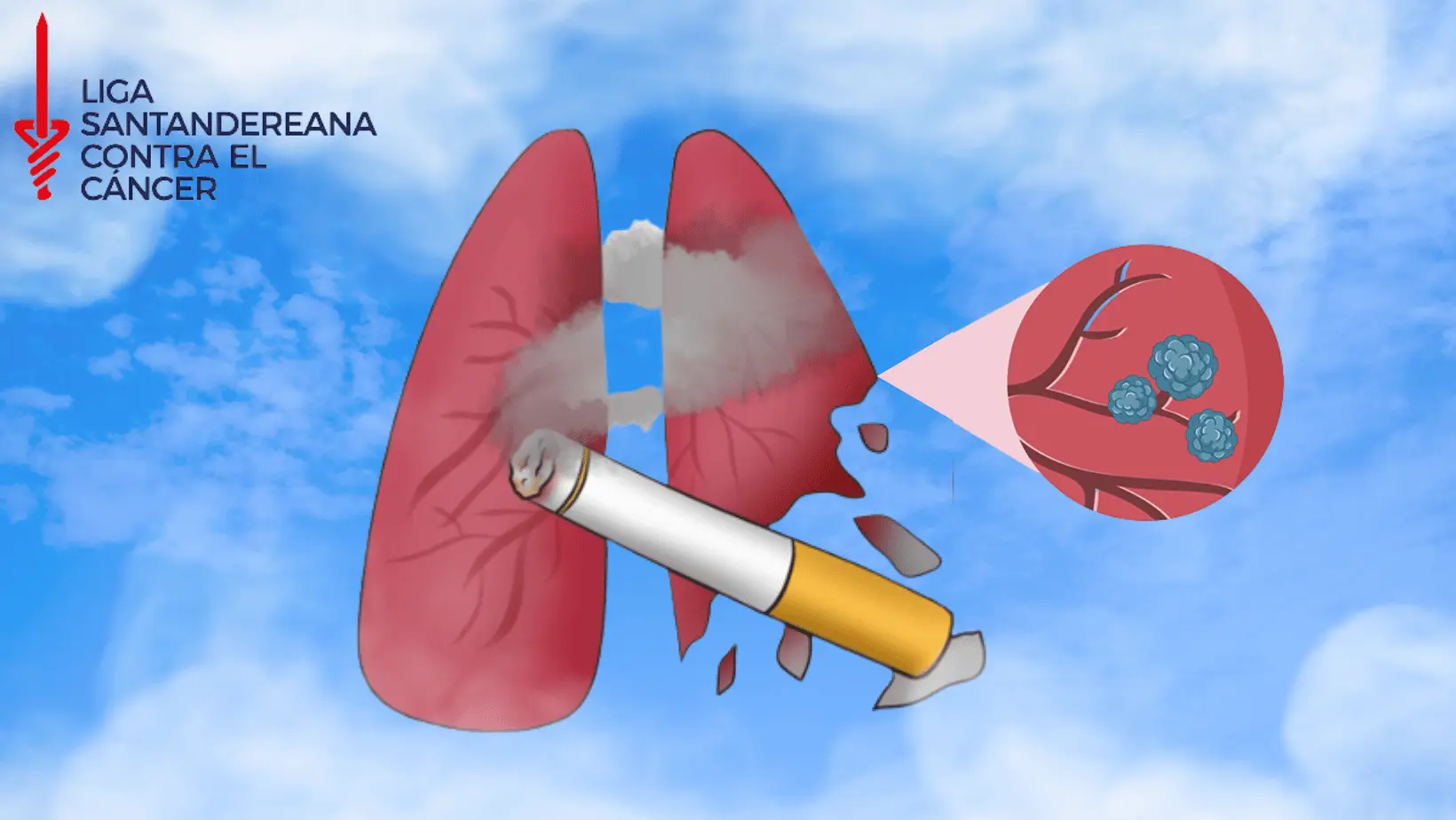 Cáncer de pulmón Infografía sobre Cáncer de pulmón