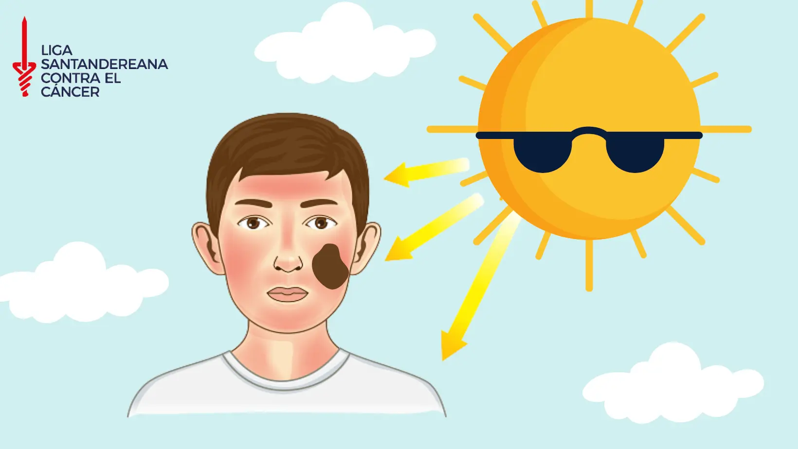 Cáncer de piel Infografía sobre Cáncer de piel